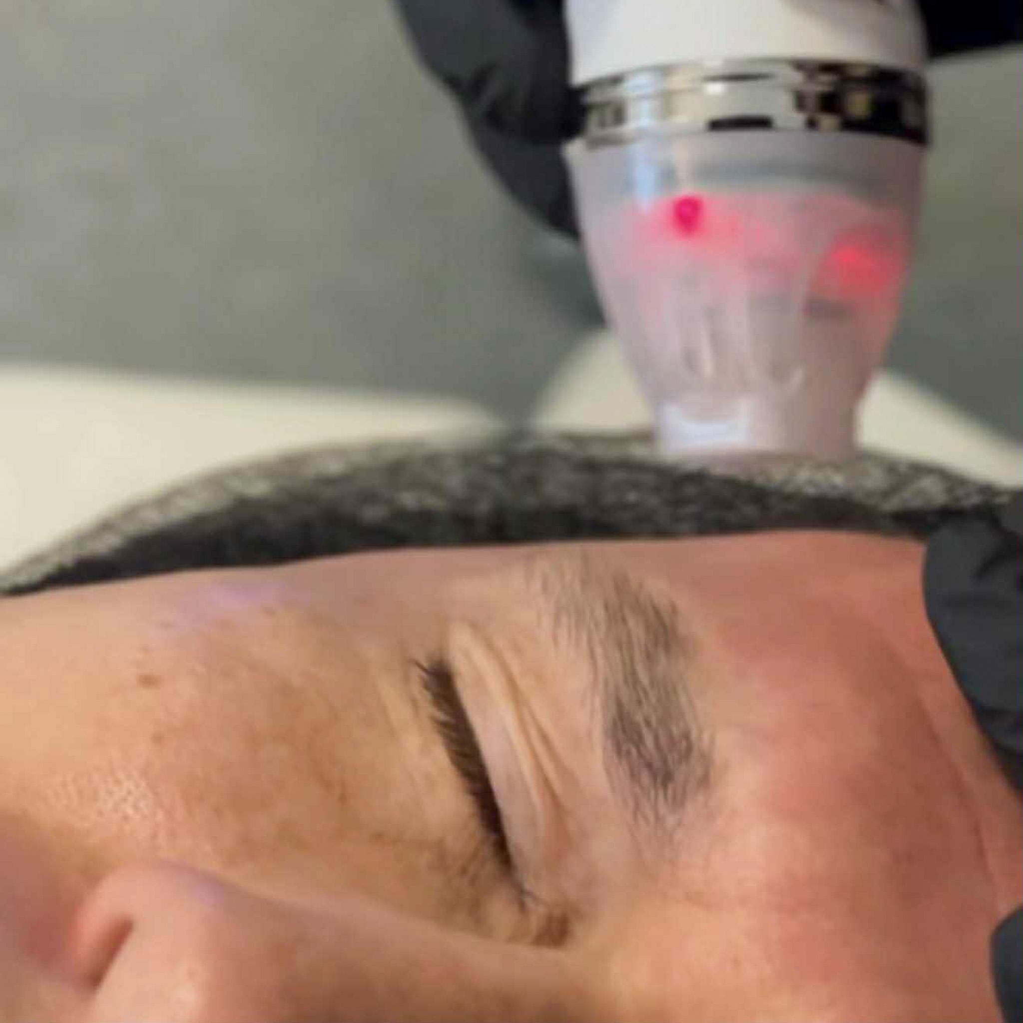 Zabieg radiofrekwencji mikroigłowej